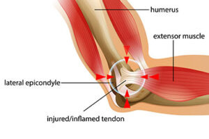 tennis elbow lateral epicondylitis